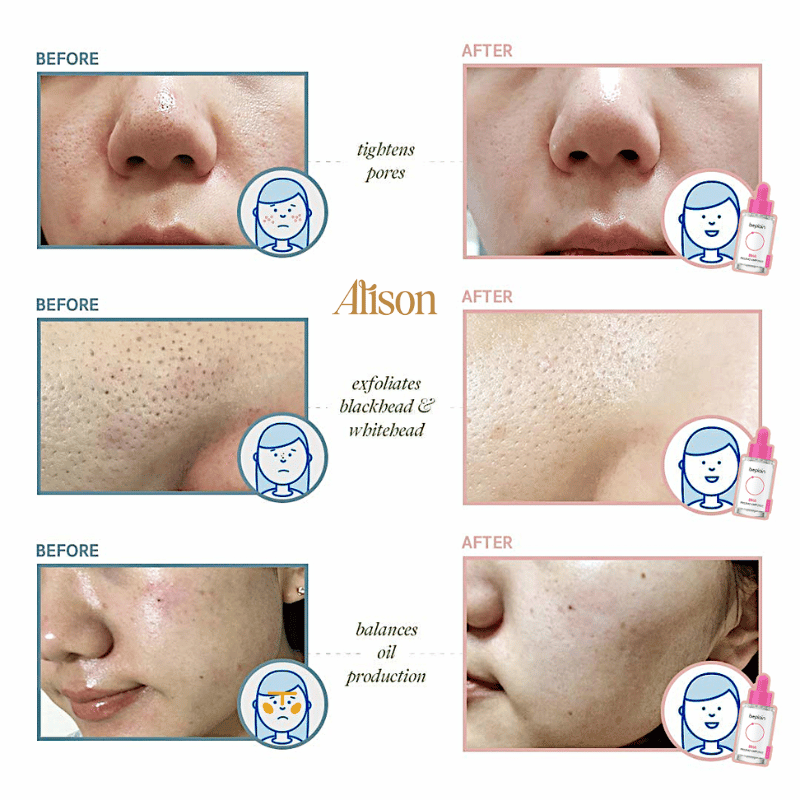 Beplain BHA Peeling Ampoule giúp cải thiện các trình trạng da  có mụn viêm nhẹ, mụn đầu đen hoặc sưng đỏ